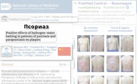 Псориаз - хроническое воспаление кожи
