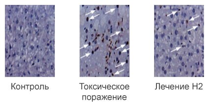 Токсическое повреждение печени