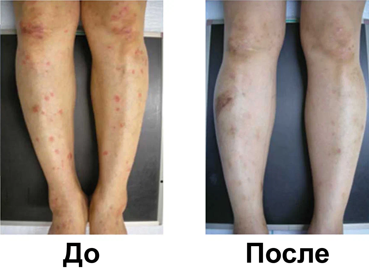 Псориаз и артрит