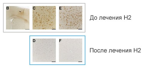Защита Н2 после черепно-мозговых травм