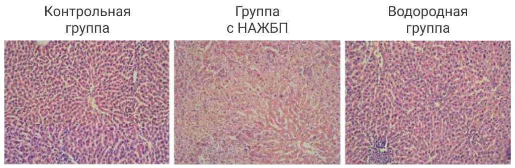 Жировая болезнь печени